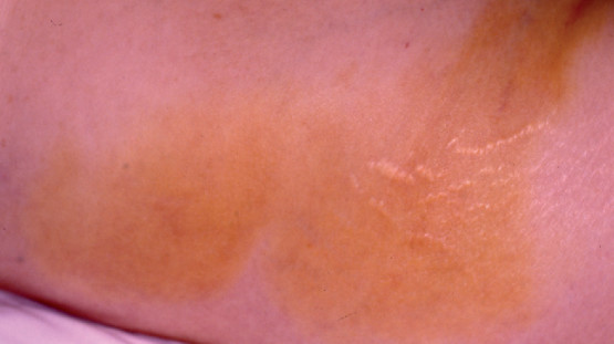 Yellow To Orange Skin Lesions Dermatology Games