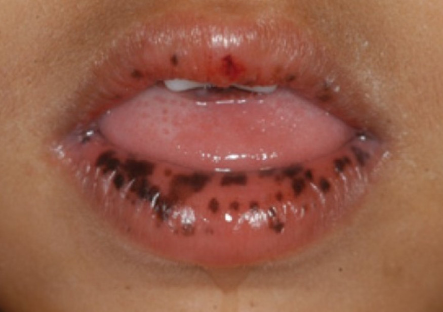 Peutz-Jeghers syndrome