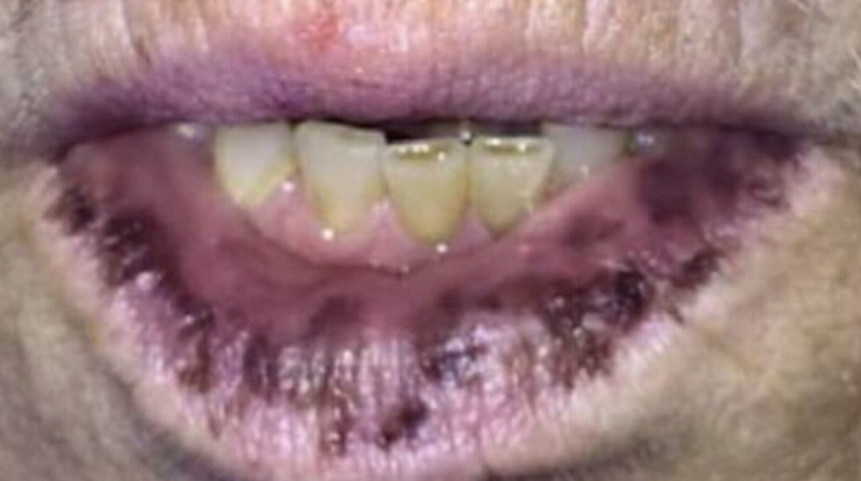 Laugier–Hunziker syndrome