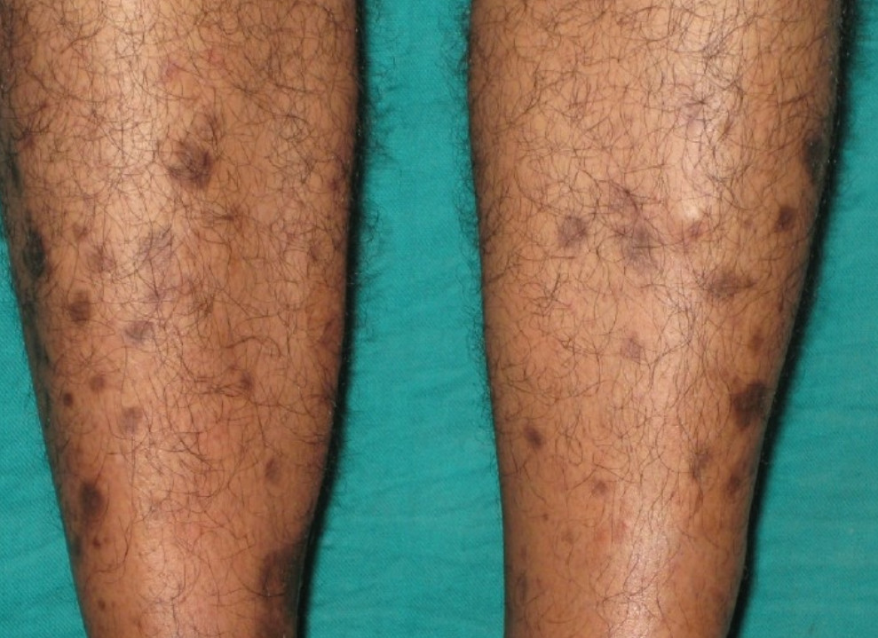 Pigmented lesions of the leg | Dermatology Games