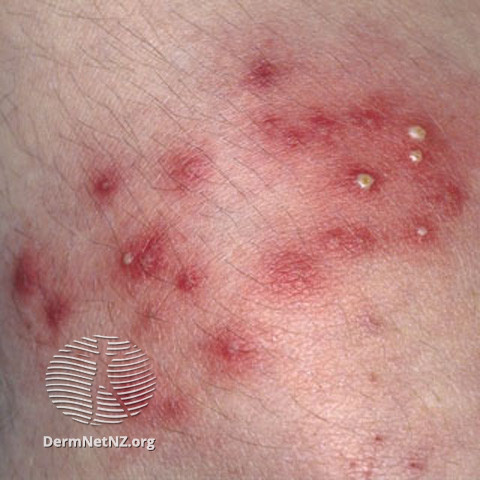 Folliculitis Definition Follikulitis Haut Bilder SWDTRE