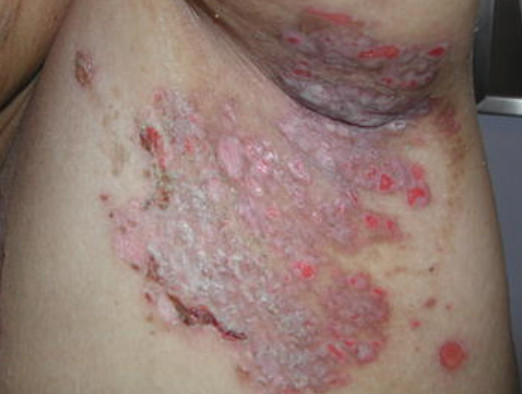 pemphigus foliaceus